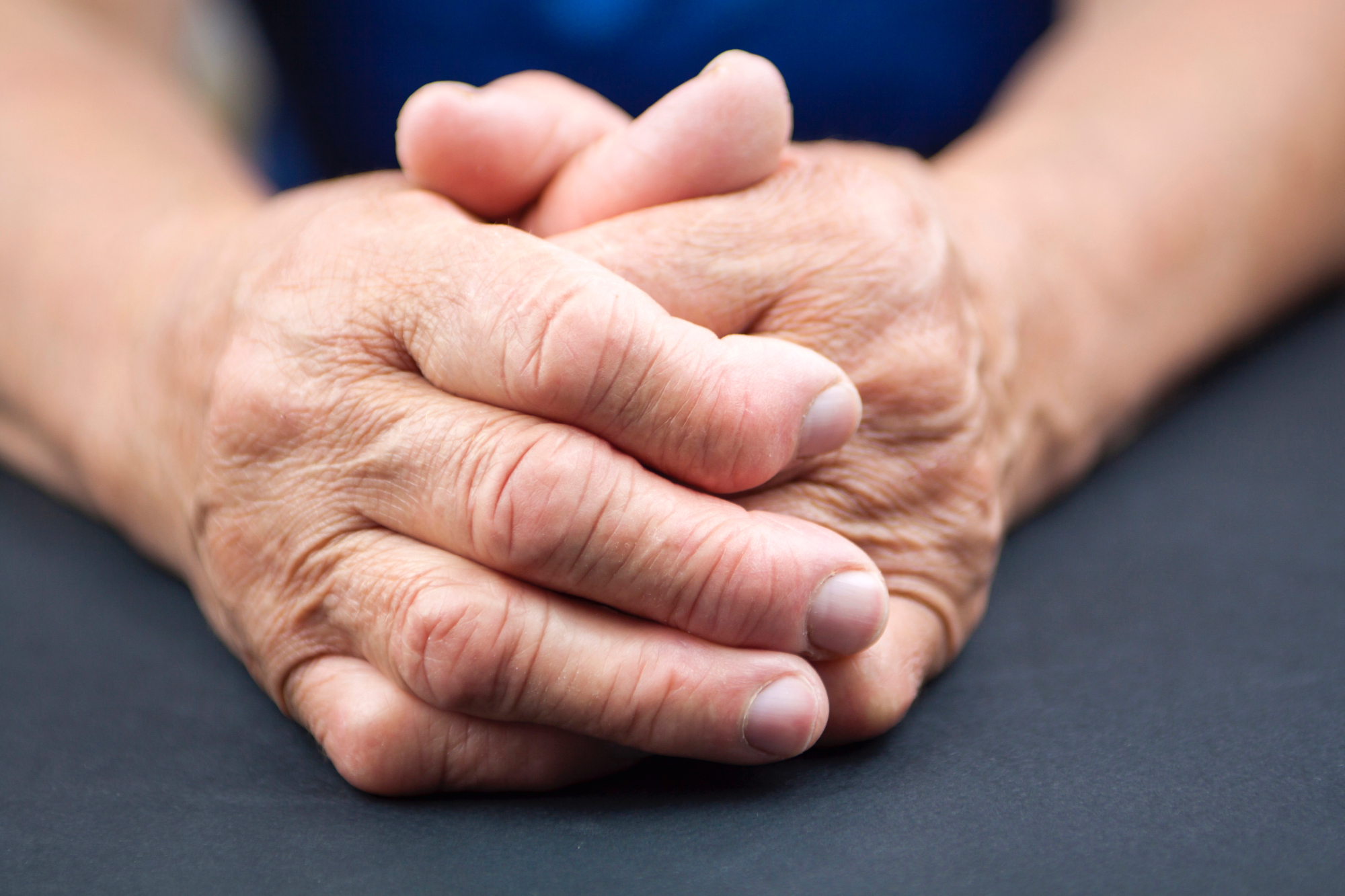 Revmatoidni artritis se večinoma pojavi pri ženskah